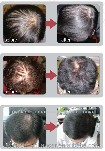 Daily need product anti bald & hair regrowth FEG Hair Growth Solution / Trending hot products 2014