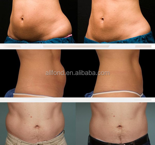Professional pure saffron extract slimming machine AF-S26 (CRYO+CAVI+RF+LASER 4 in 1)