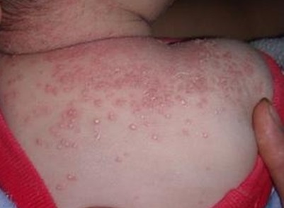 L- cystéine traitement des conditions de peau comme l L- cystéine traitement des conditions de peau comme l