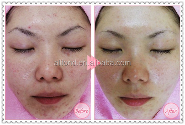 ダイヤモンドのmicrodermabrasionの熱い販売のスキンケア問屋・仕入れ・卸・卸売り
