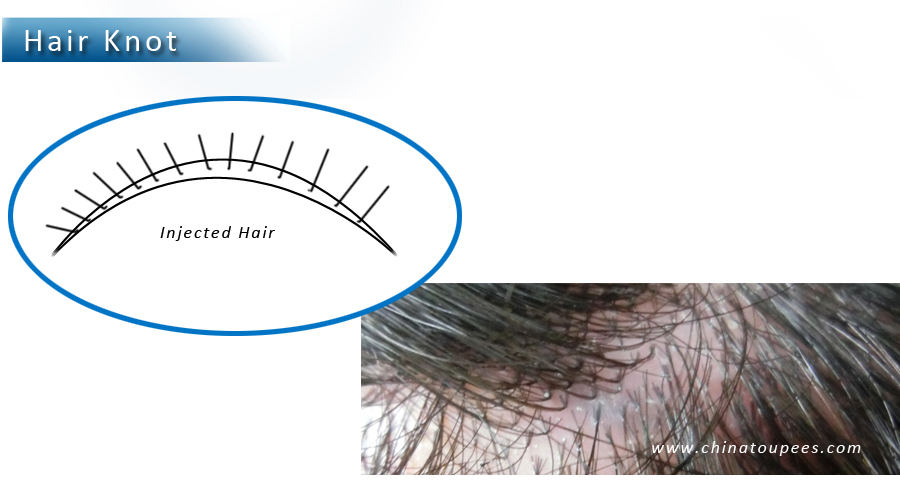 Derma roller for hair loss treatment,hair loss treatment for black men,hair loss treatment-injected hair system.jpg