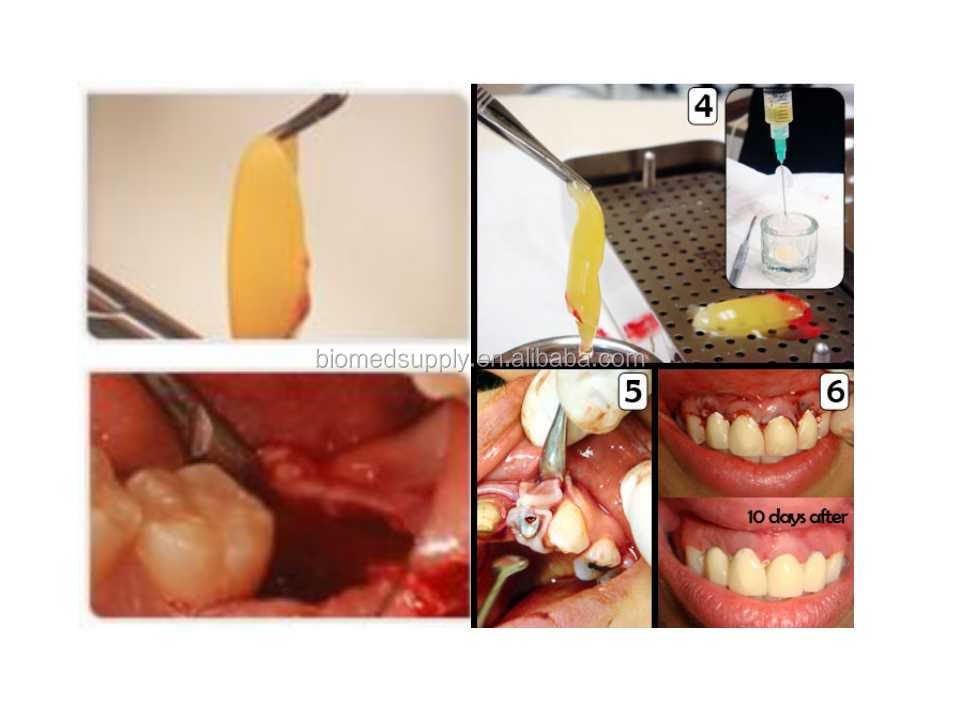 PRF FOR DENTAL.jpg