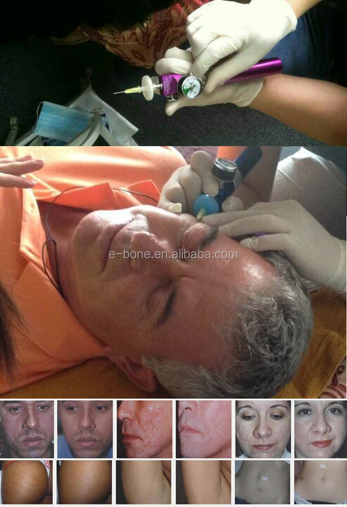 2014 portable skin care CO2 Carboxytherapy Machine carboxy therapy machine carboxtherapy equipment問屋・仕入れ・卸・卸売り