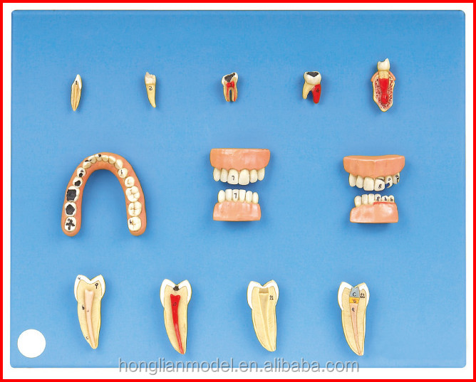 Gd/b10017歯科疾患モデル( の解剖学的モデル)仕入れ・メーカー・工場