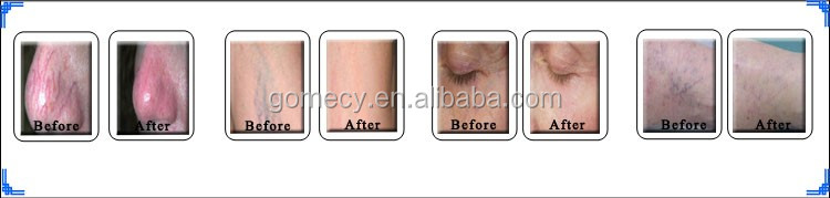 Laser Treatment For Varicose Veins Removal Acne Removal And Pigment RemovalSpider Vein Capillary Varicose Removal Professional Use 980nm Laser Machine.jpg